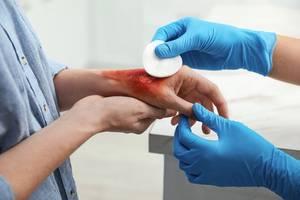 chicago burn injury lawyer